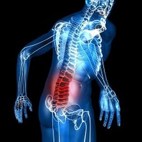 osteochondroza