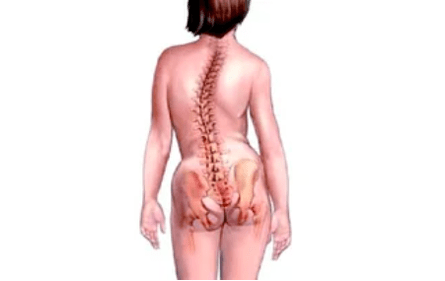 przyczyny rozwoju osteochondrozy szyjnej