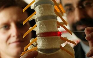 Objawy i leczenie osteochondrozy kręgosłupa klatki piersiowej