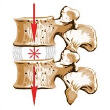 Urządzenie kręgosłupa i przyczyny osteochondrozy